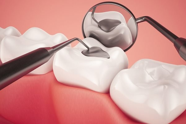 Giải pháp trám răng tốt nhất 2024 mà cộng đồng Tdentist khuyên bạn là gì?